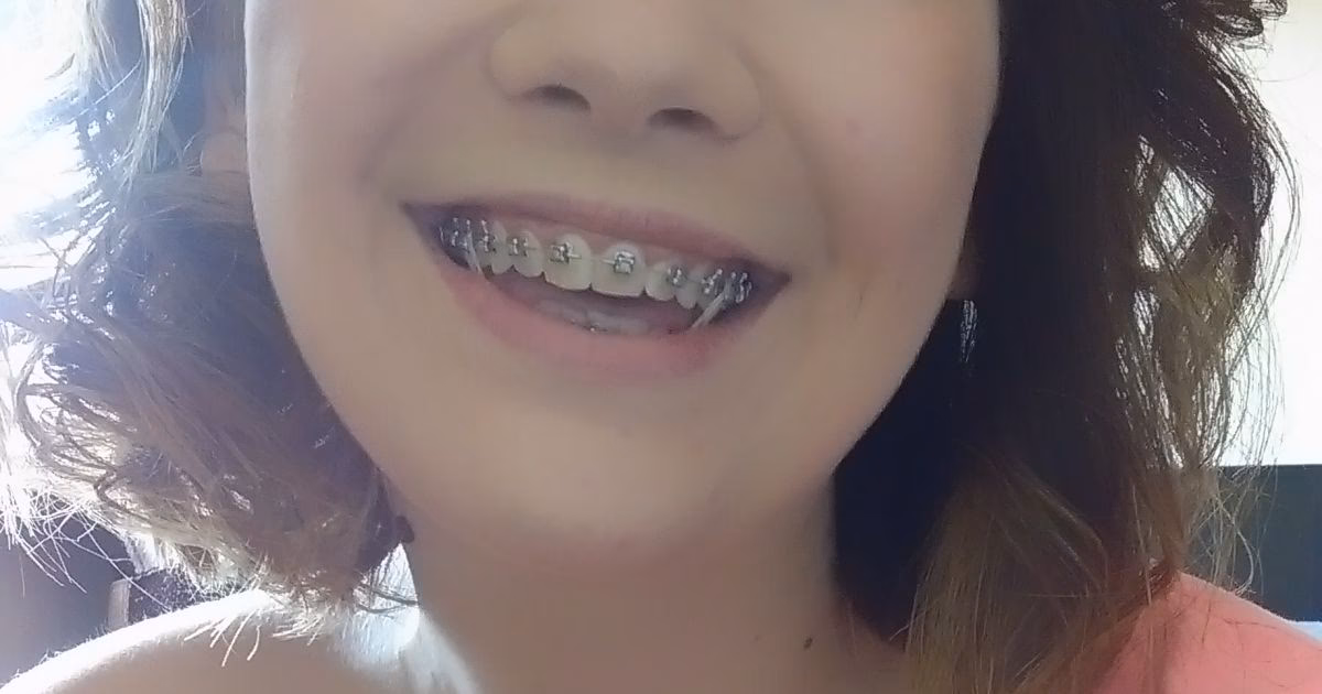 Czy aparat Damon jest dobry?