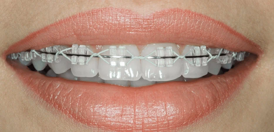 Co uważa się za aparat ortodontyczny kosmetyczny?