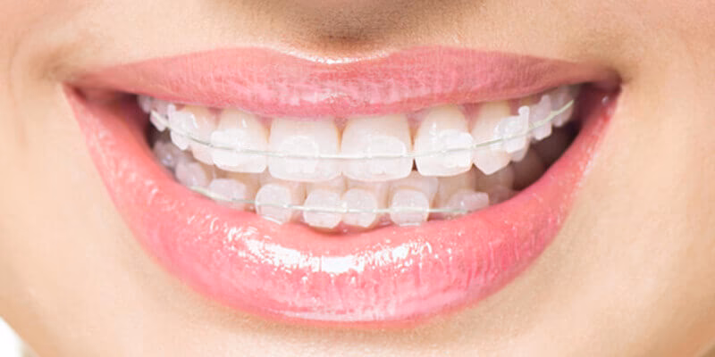 Ile kosztuje aparat kryształowy?