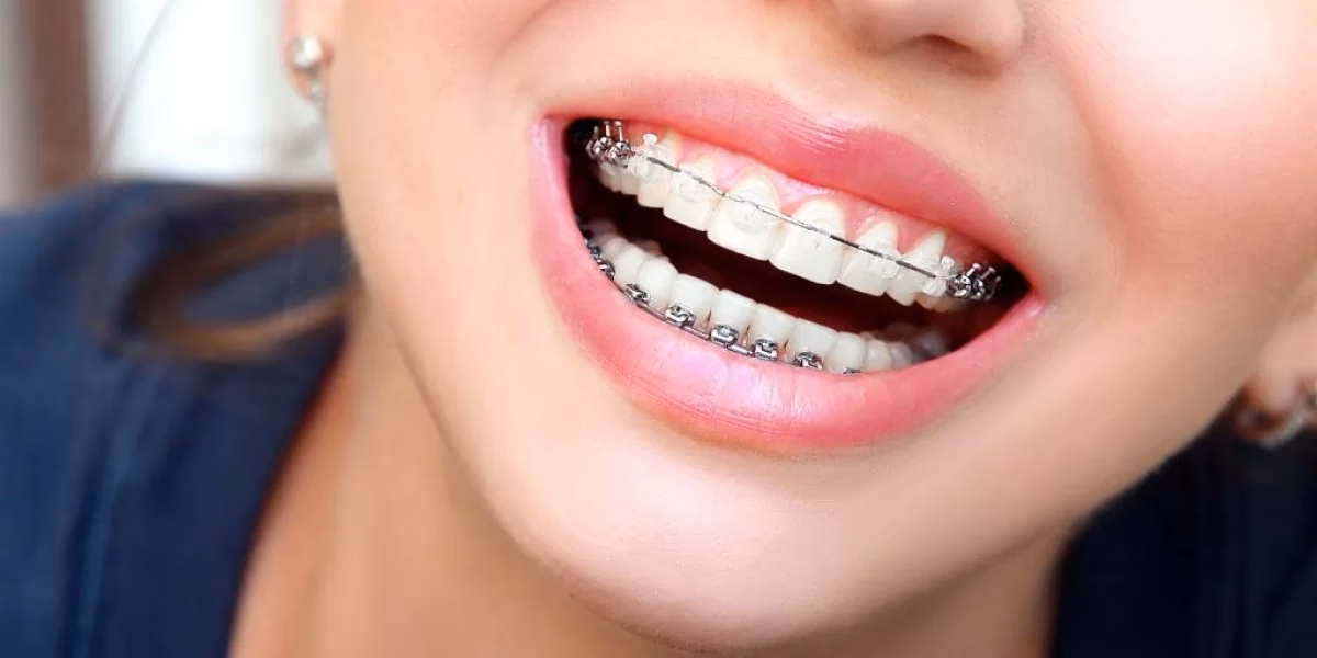 Czym się różni aparat metalowy od porcelanowego?