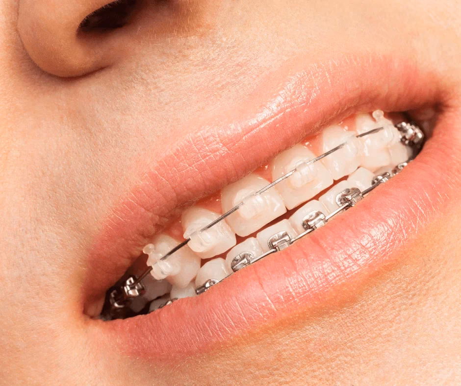 Ile kosztuje aparat ortodontyczny kosmetyczny?
