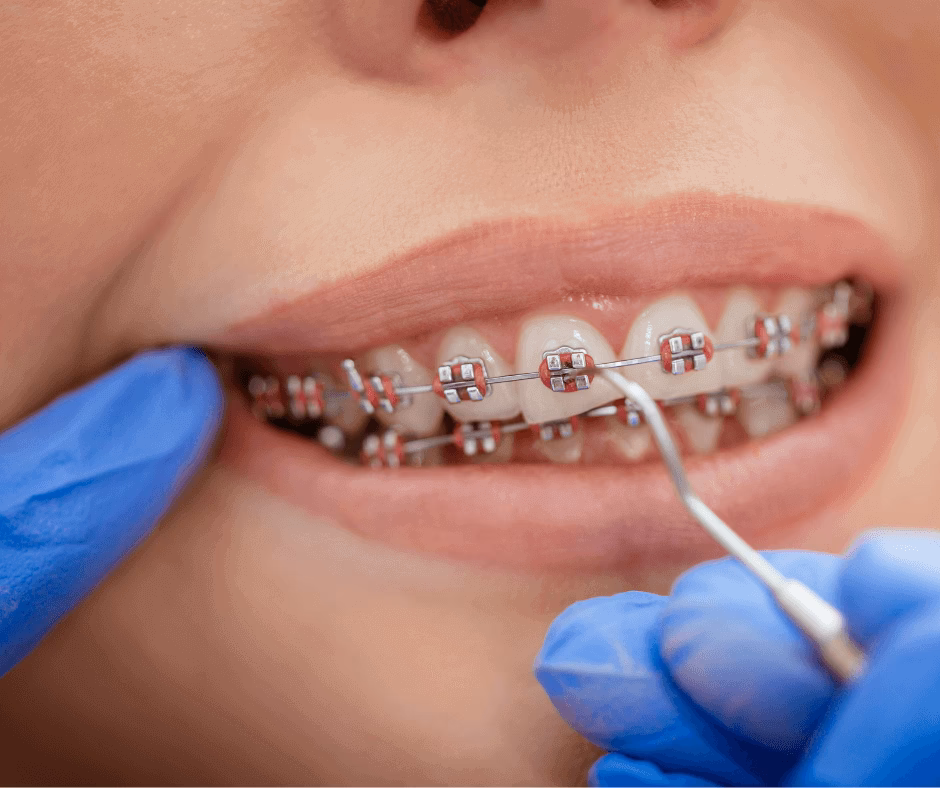 Ile kosztuje aparat ortodontyczny kosmetyczny?