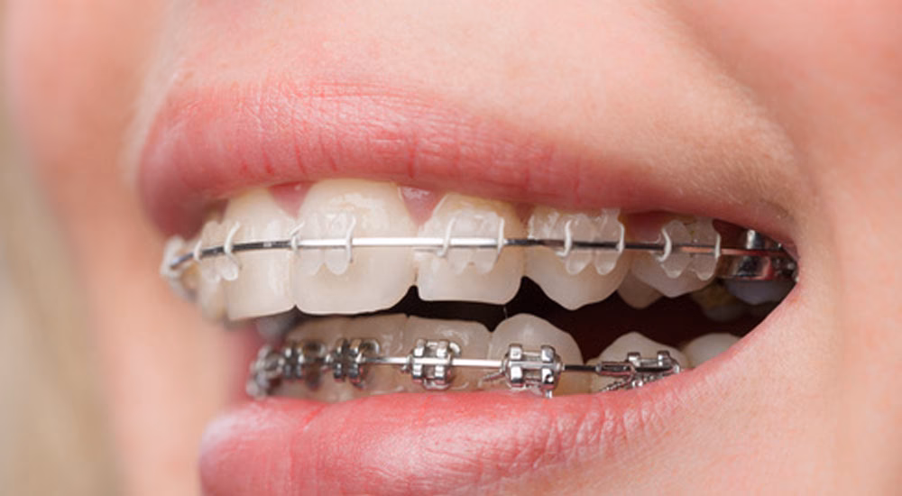 Ile kosztuje aparat ortodontyczny w Krakowie?
