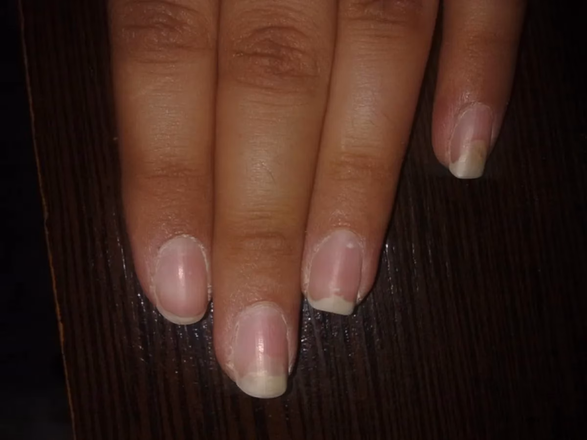 Czy można robić paznokcie przy atopowym zapaleniu skóry?