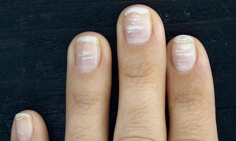 Czego nie lubi atopowe zapalenie skóry?