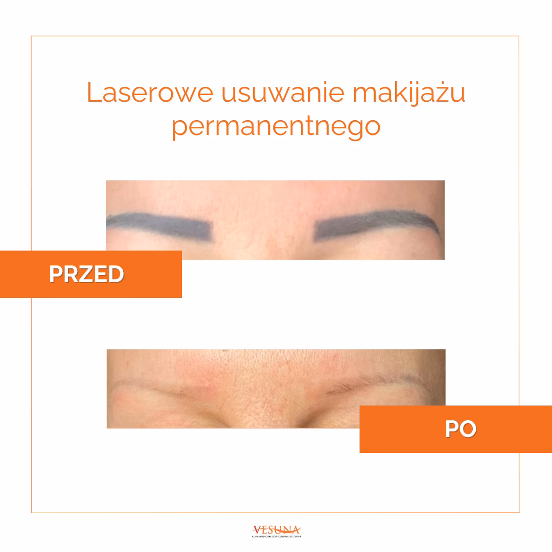 Czy usuwanie brwi removerem jest bolesne?