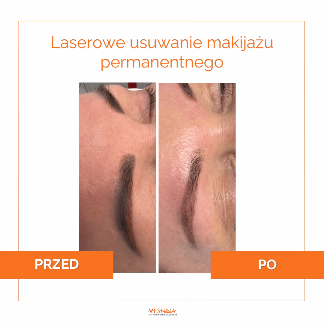 Ile kosztuje laserowe usunięcie brwi permanentnych?