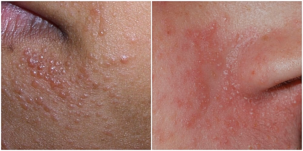 Jak pozbyć się białych kropek na brodzie?