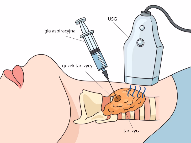 Jak przygotować się do biopsji guzka tarczycy?