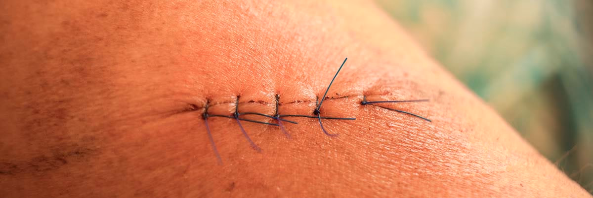 Co to jest blizna patologiczna?