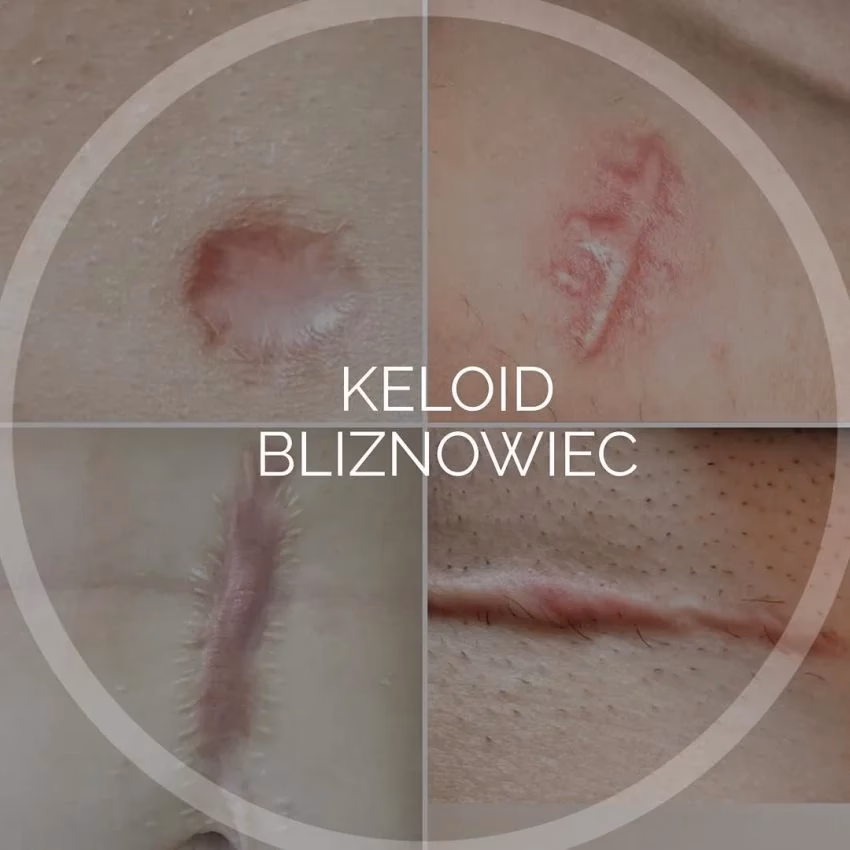 Jakie zabiegi na bliznowca?