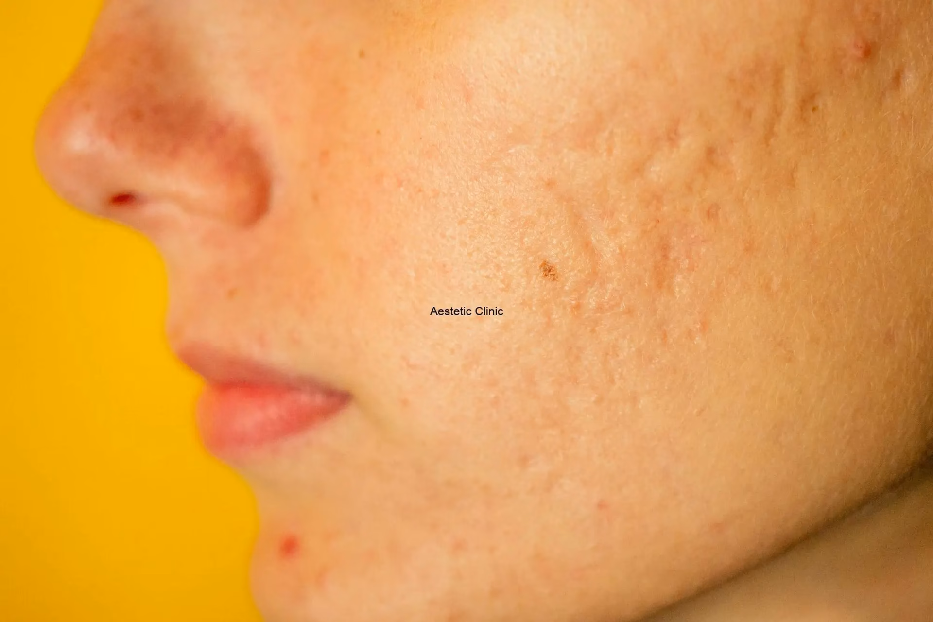 Jak wygląda twarz po ospie?