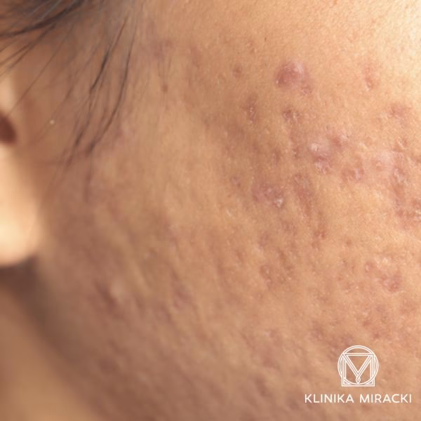 Czym zakryć blizny po ospie?