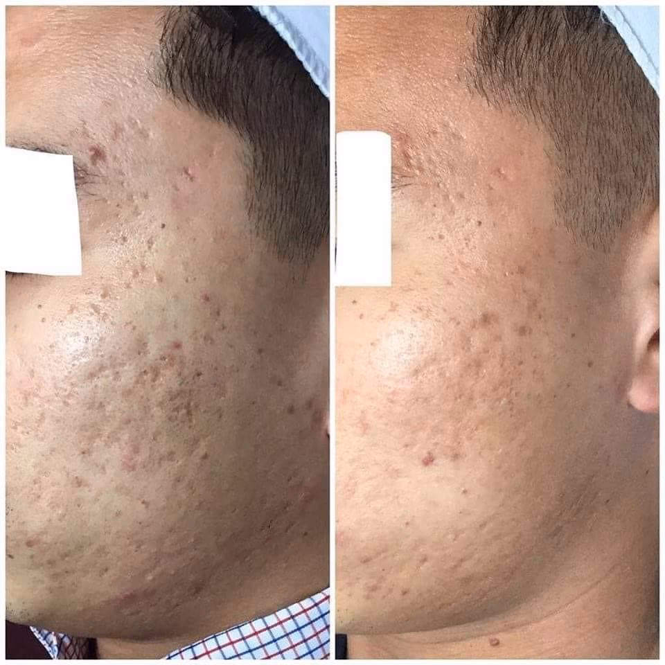 Czy blizna zanikowa zniknie?