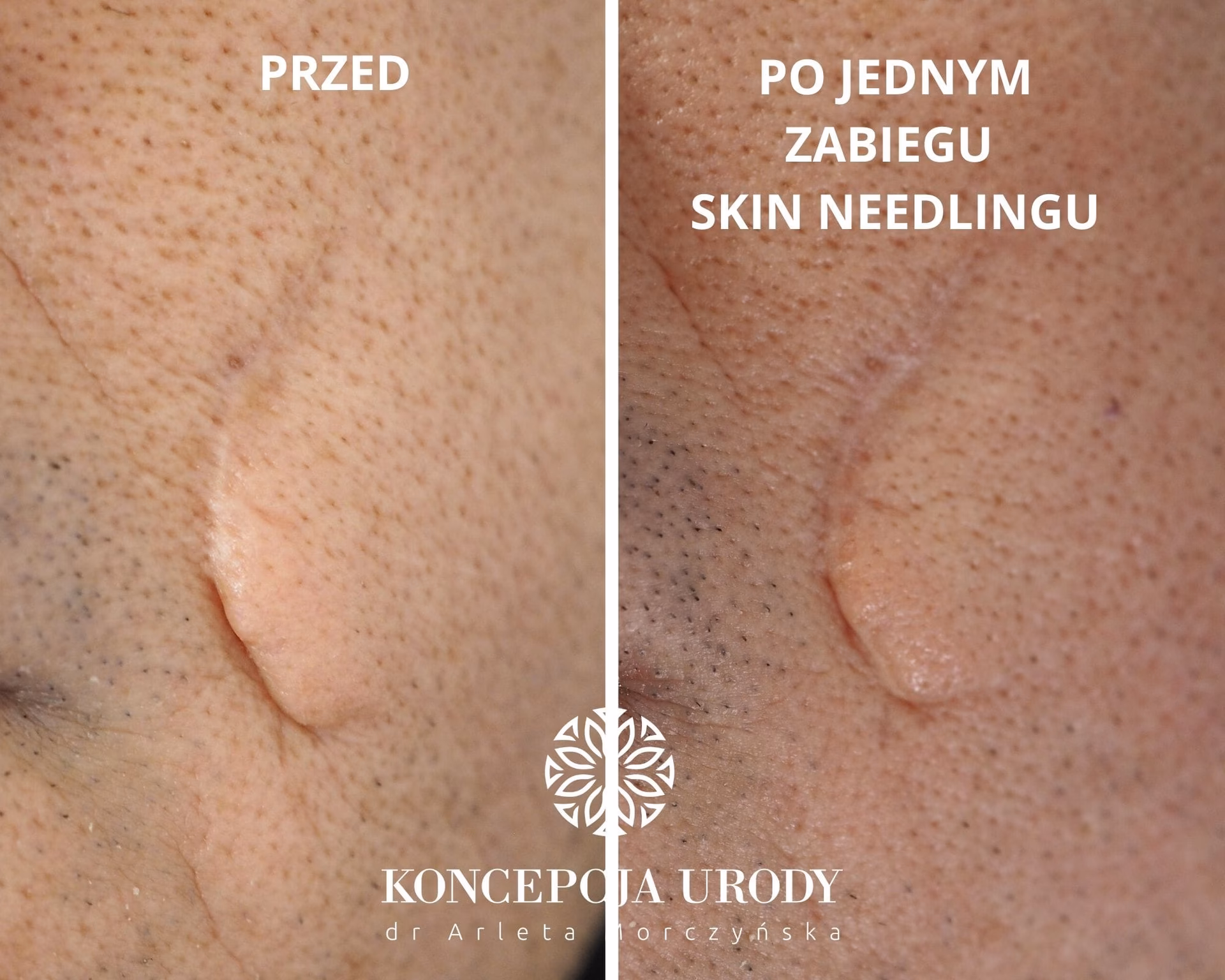 Czy blizny zanikowe da się usunąć?