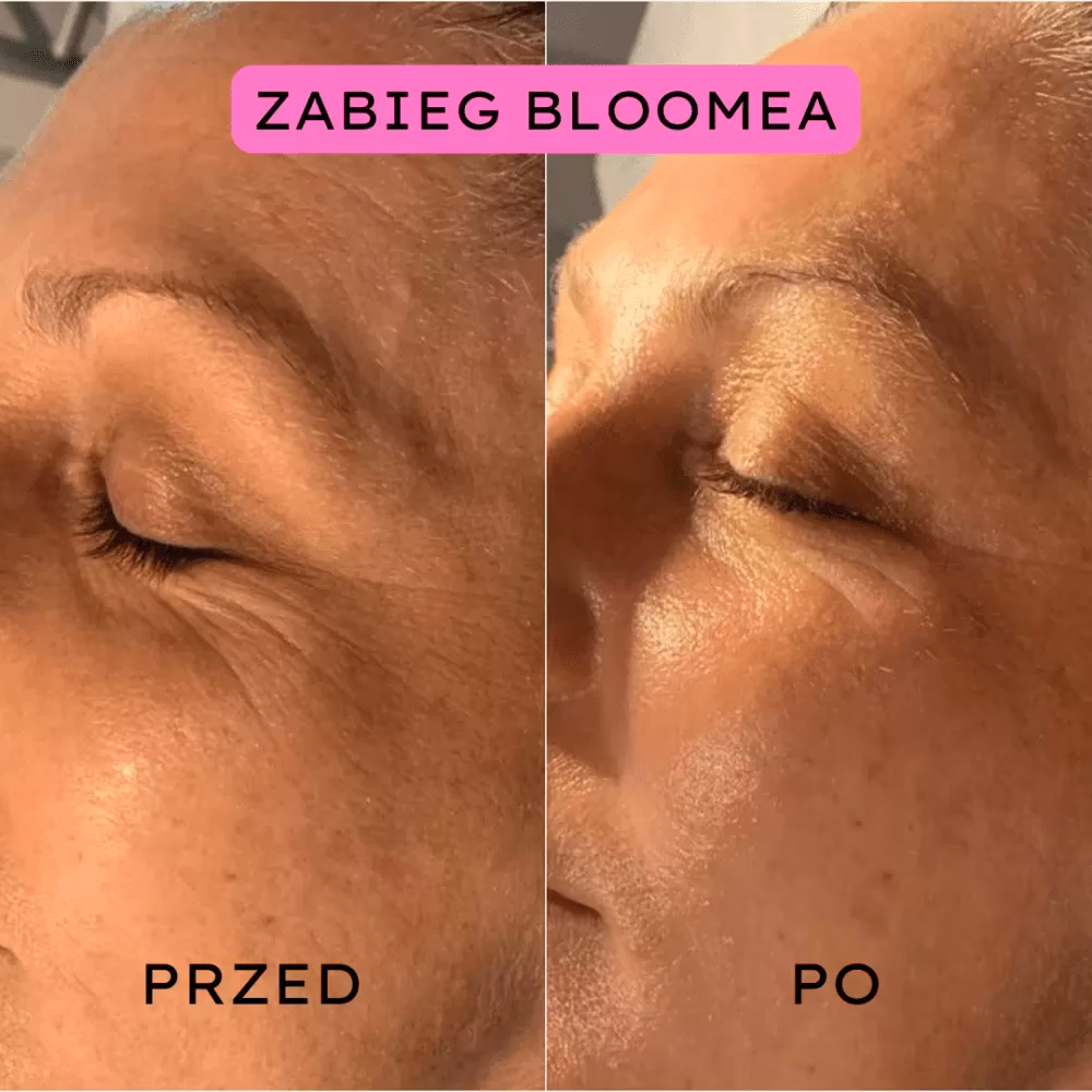 Co daje zabieg Bloomea?