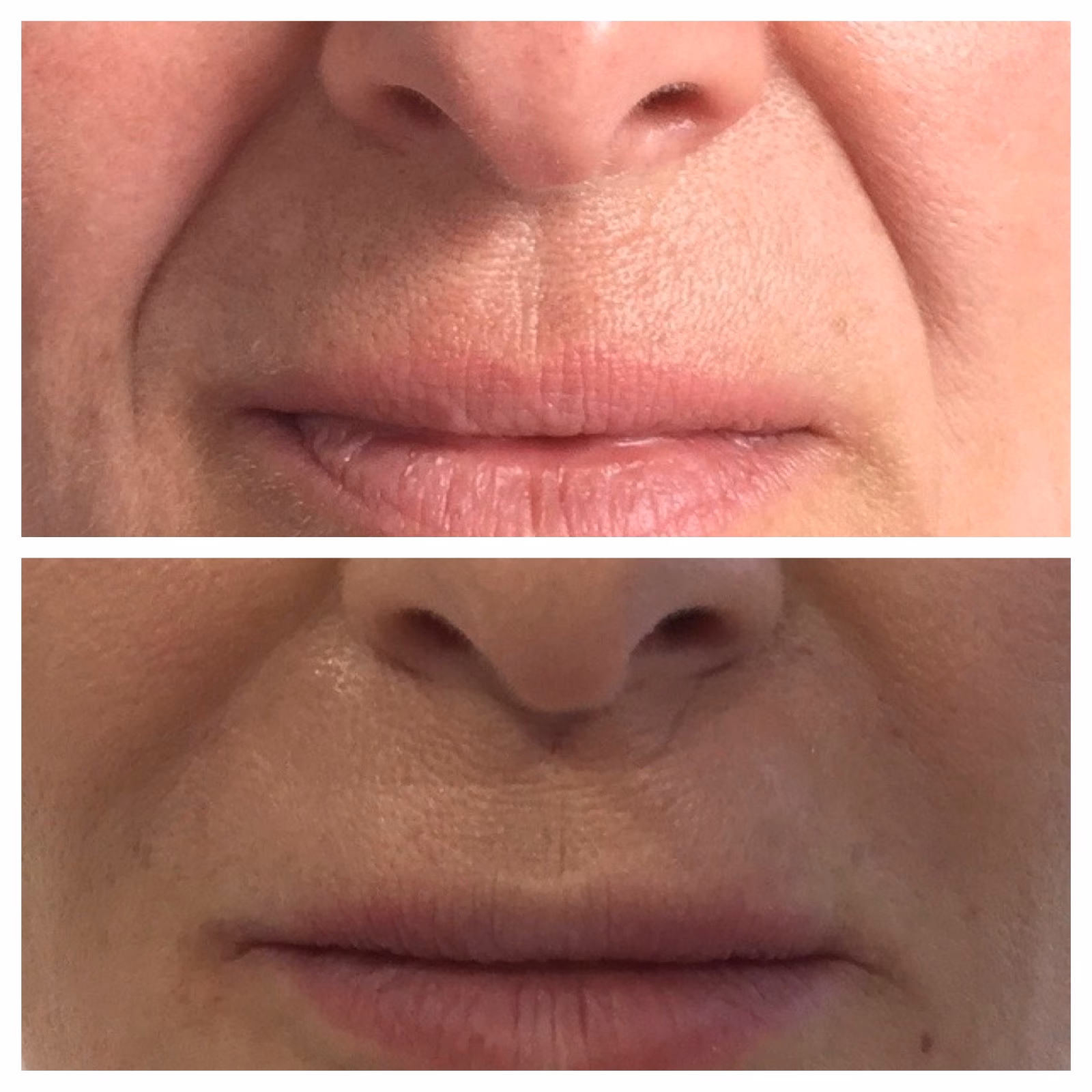 Jak ukryć bruzdy nosowo-wargowe makijażem?