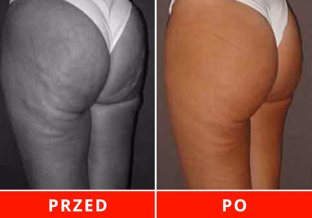 Jaki hormon powoduje cellulit?