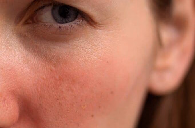 Jakich zabiegow nie robić przy cerze naczynkowej?