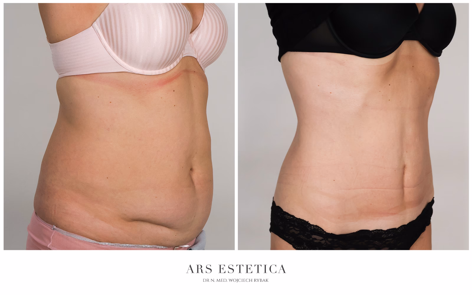Jaki jest zabieg usunięcia skóry z brzucha?