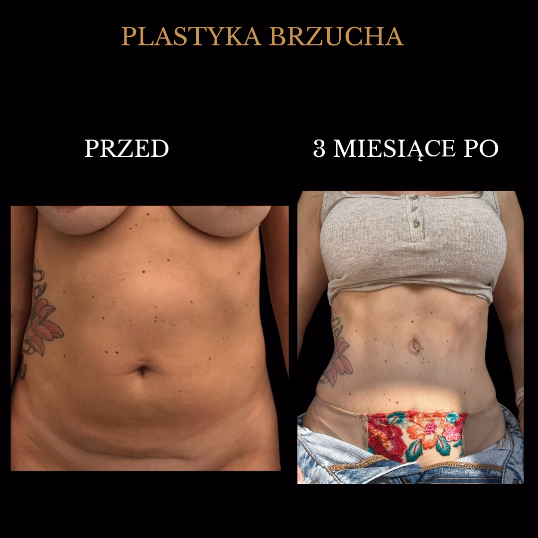 Ile kosztuje usuwanie skóry z brzucha?