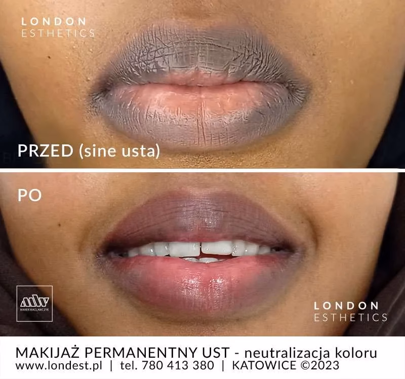 Czy ciemne usta są zdrowe?