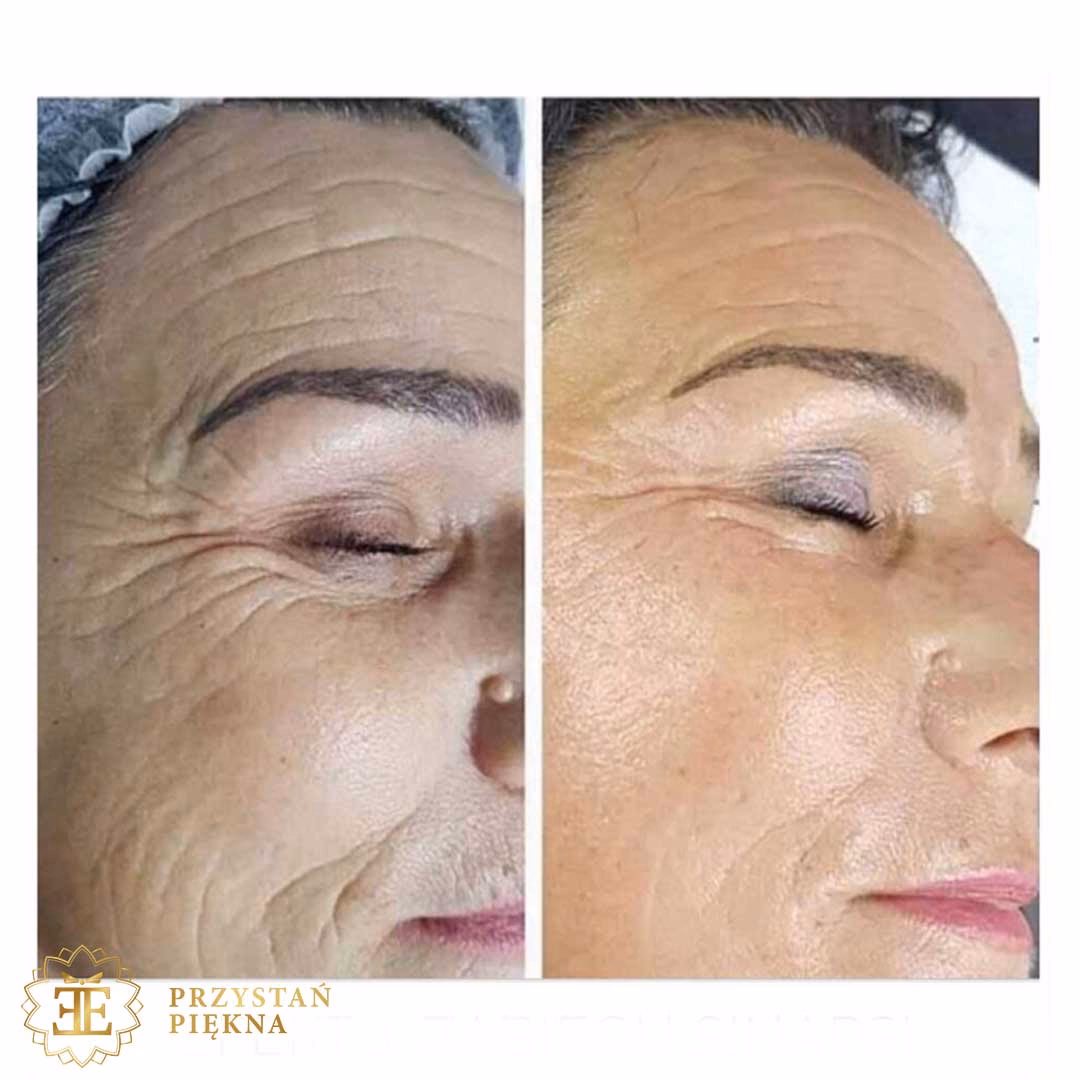 Ile kosztuje zabieg na sińce pod oczami?