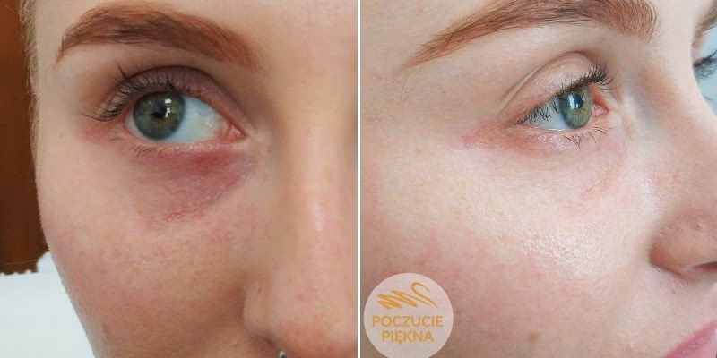 Ile kosztuje zabieg na sińce pod oczami?