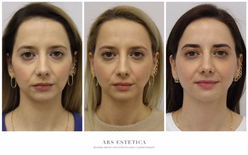 Jaki jest najlepszy zabieg na cienie pod oczami?