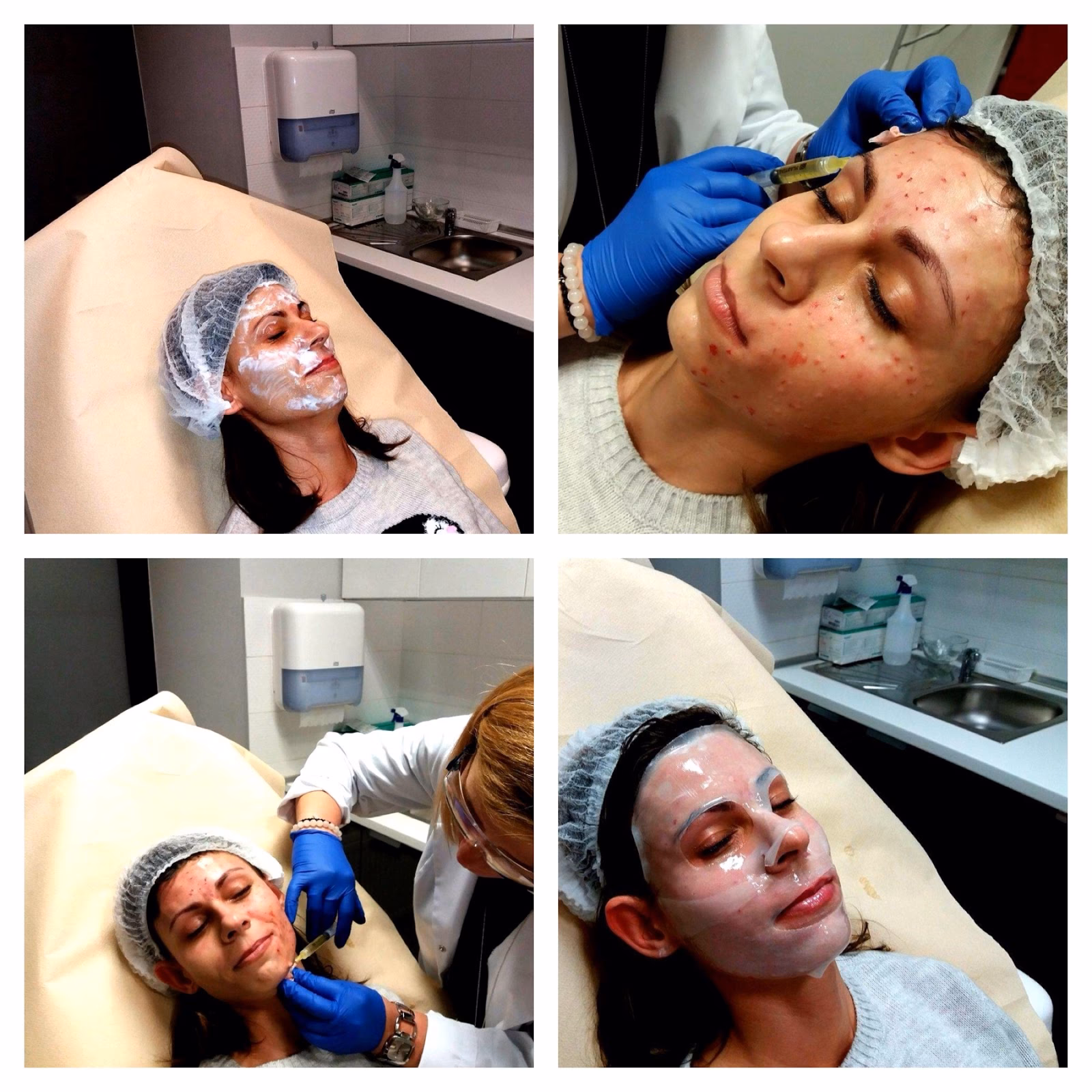 Jak wygląda twarz po wampirzym liftingu?