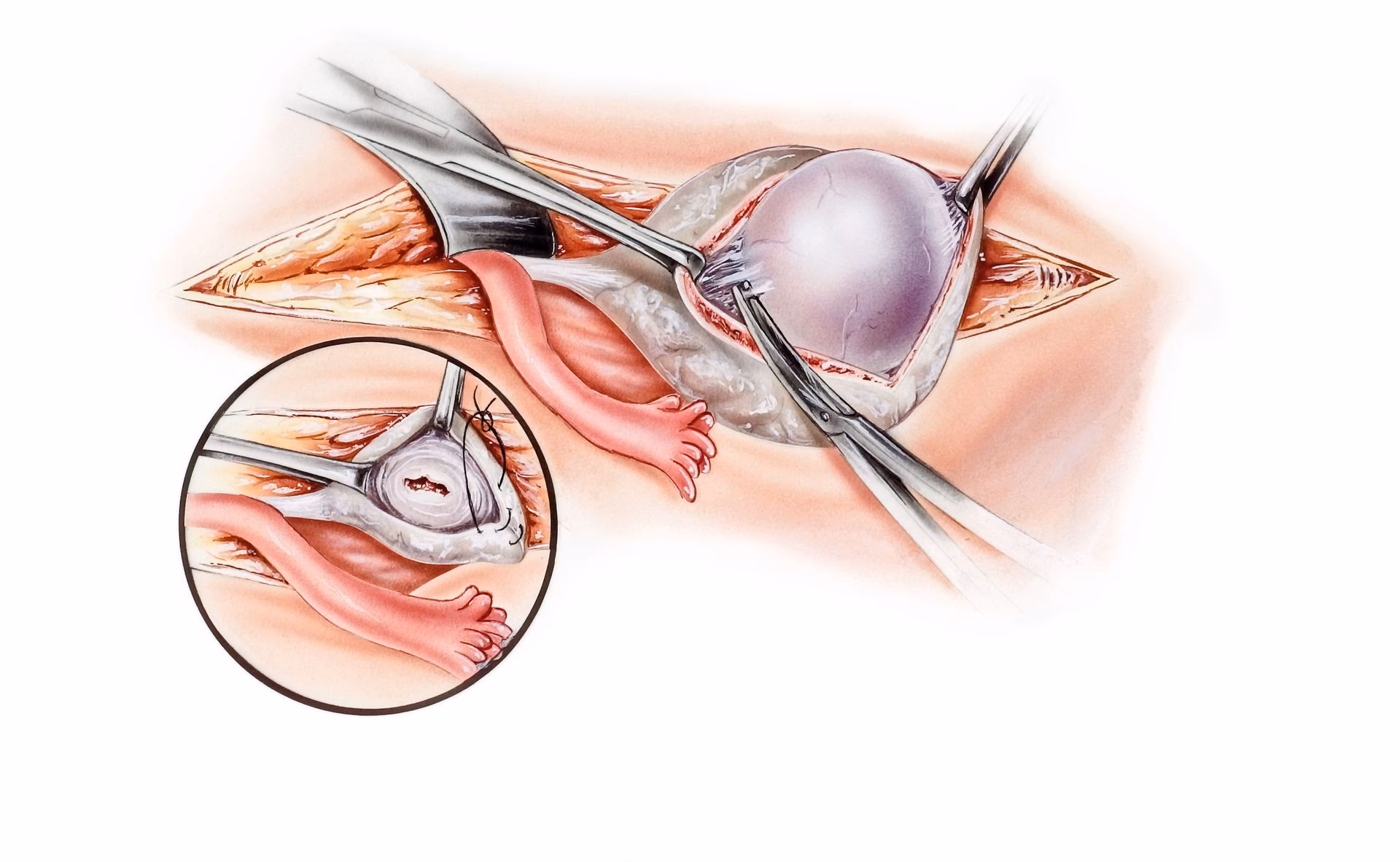 Jak szybko pozbyć się cysty?