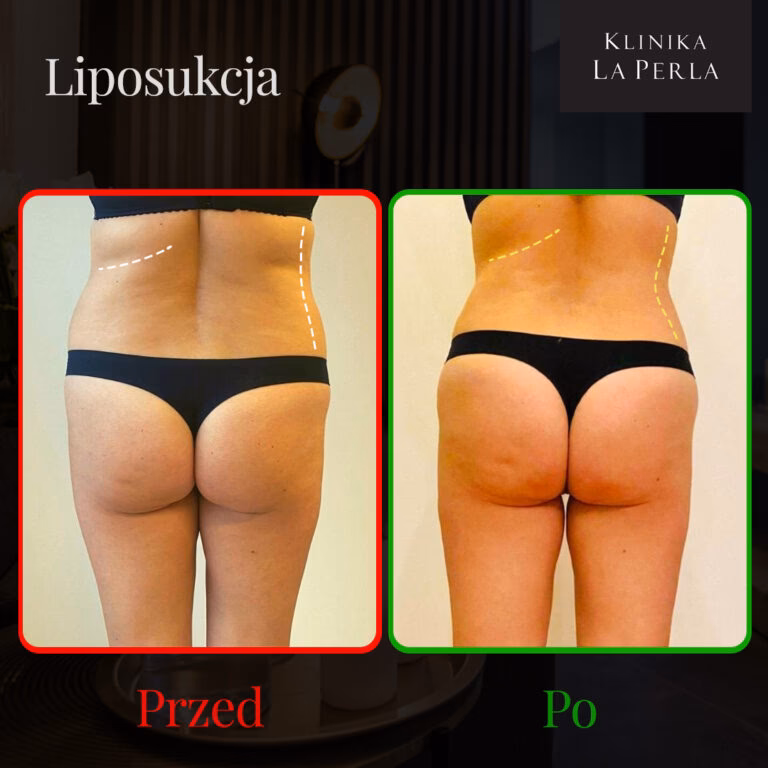 Czy odsysanie tłuszczu jest skuteczne?