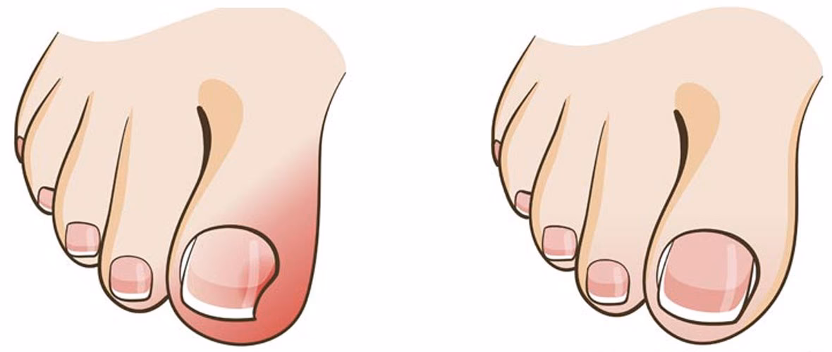 Jaki lekarz zajmuje się wrastającymi paznokciami?