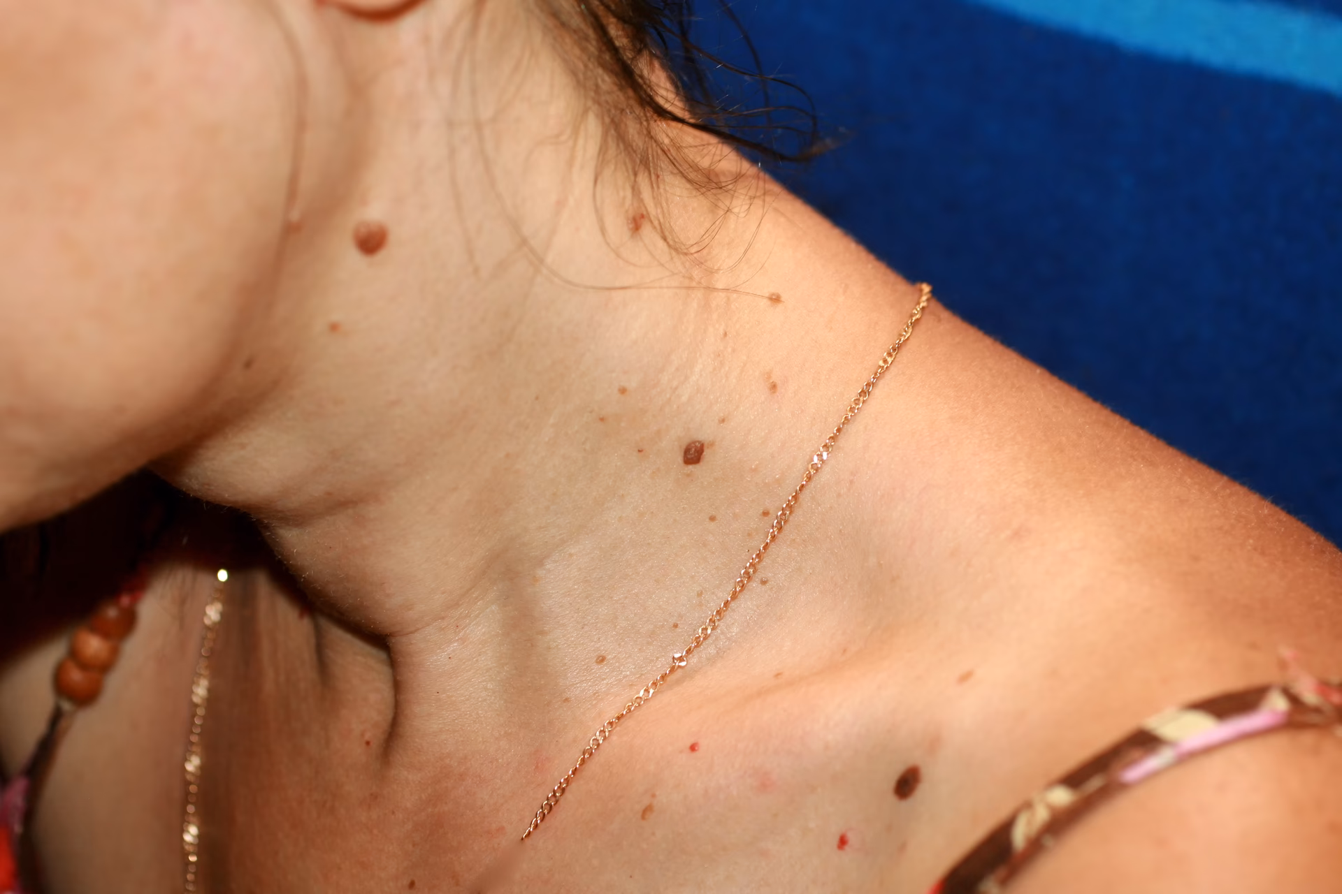 Czy kosmetyczka może usunąć włókniaki?