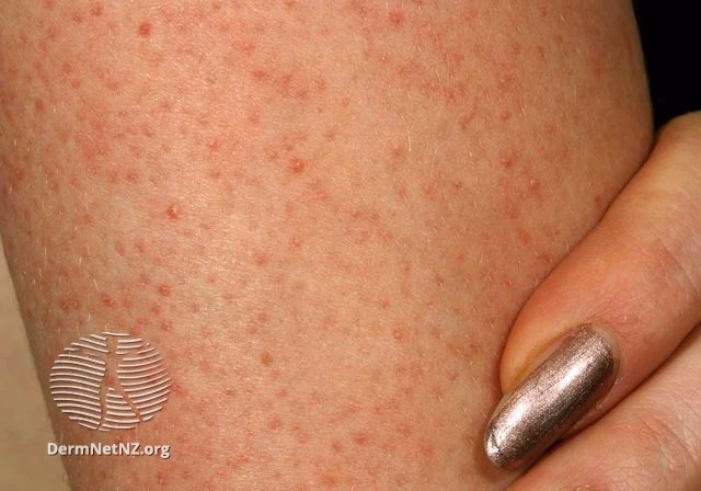 Jak pozbyć się rogowacenia okołomieszkowego?