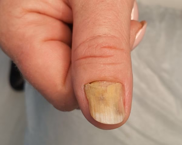 Ile kosztuje pirolam od grzybicy paznokci?