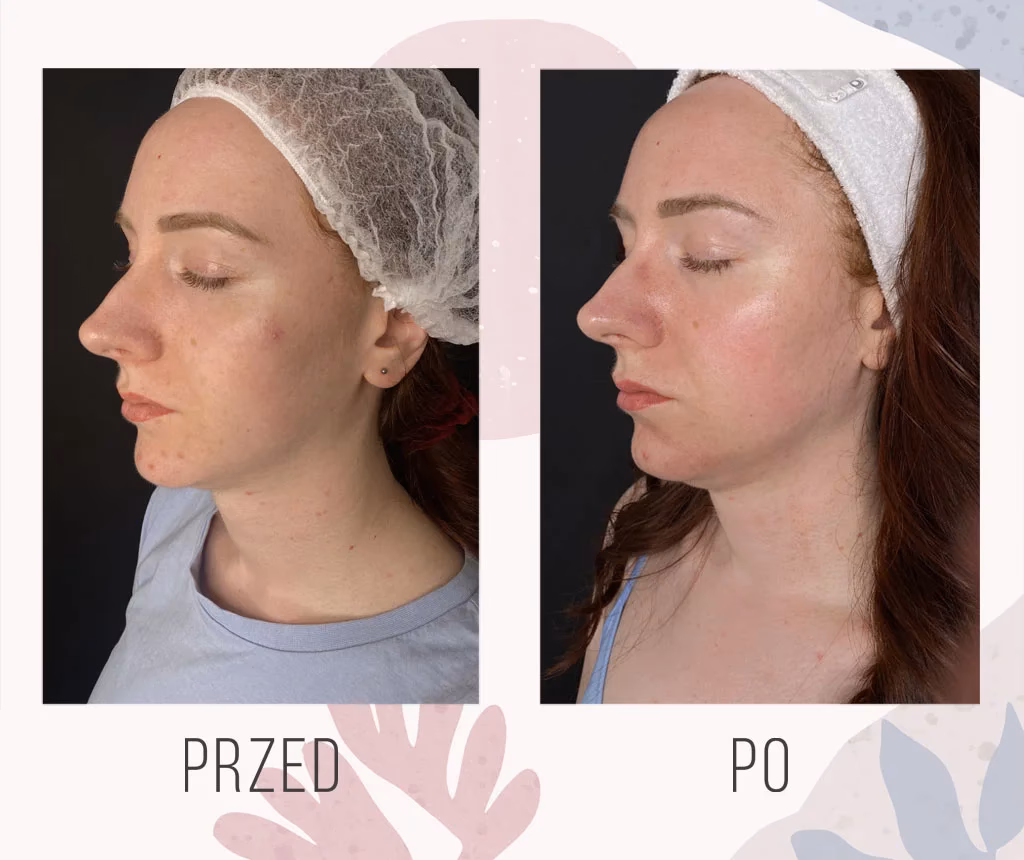 Czy przy nowotworze można robić botoks?