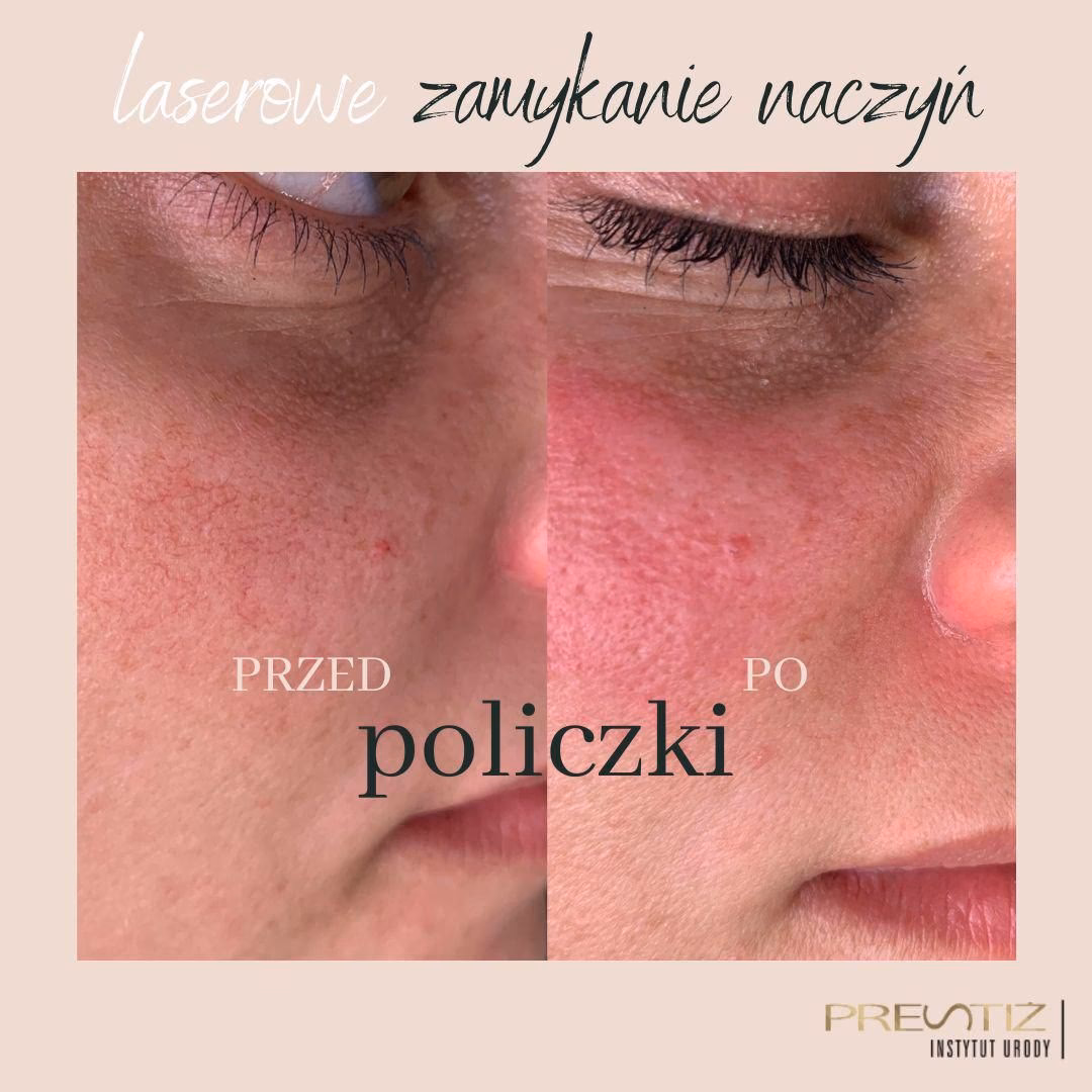 Czy po laserze można pić kawę?