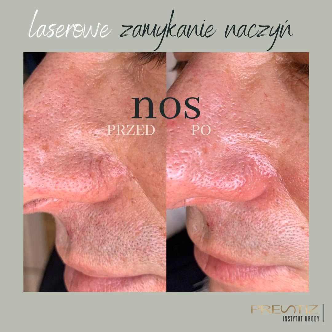 Jakie są zalecenia po zabiegu usuwania rumienia laserem?