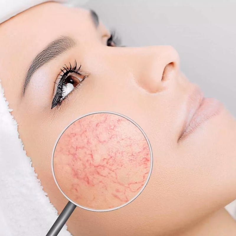 Czy po laserze IPL można się malować?