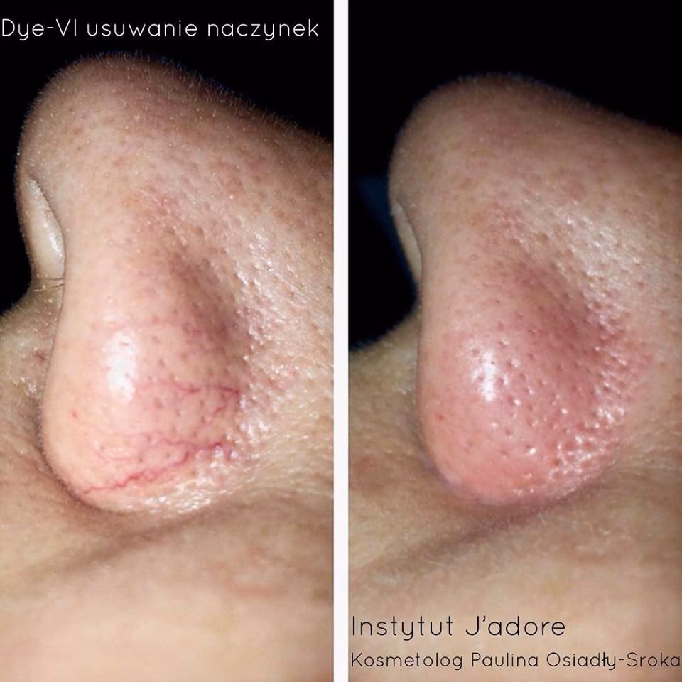 Kto usuwa pajączki na nogach?