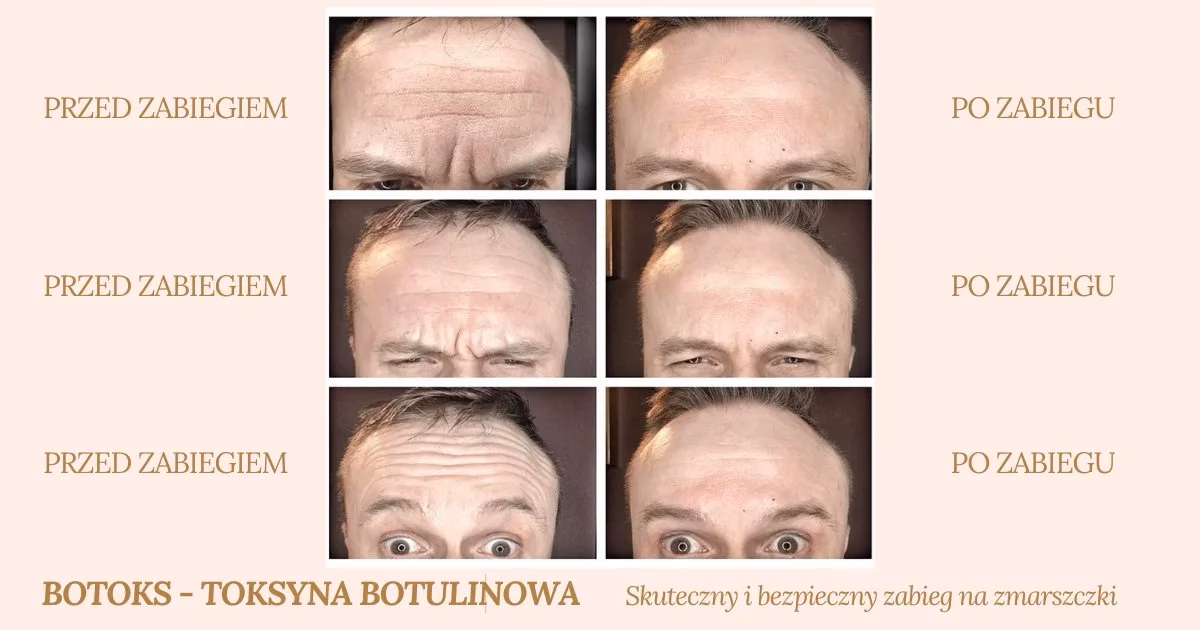 Jaki zabieg napina skórę twarzy?