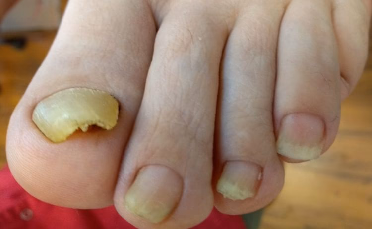 Jak odbudować paznokcie u stopy?