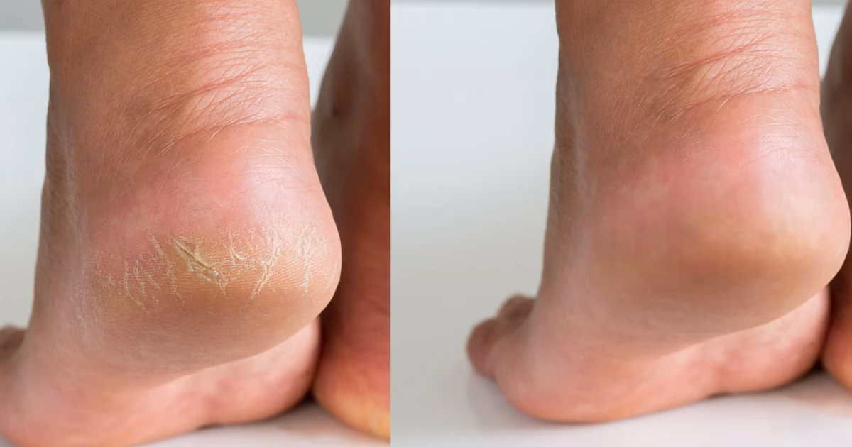 Czym najlepiej czyścić pięty?