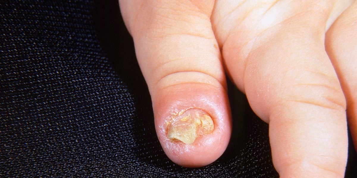 Co jeśli wycisnęłam czyraka?