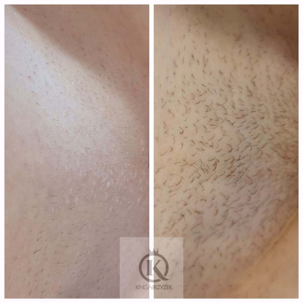 Czy włoski po laserze wypadają?