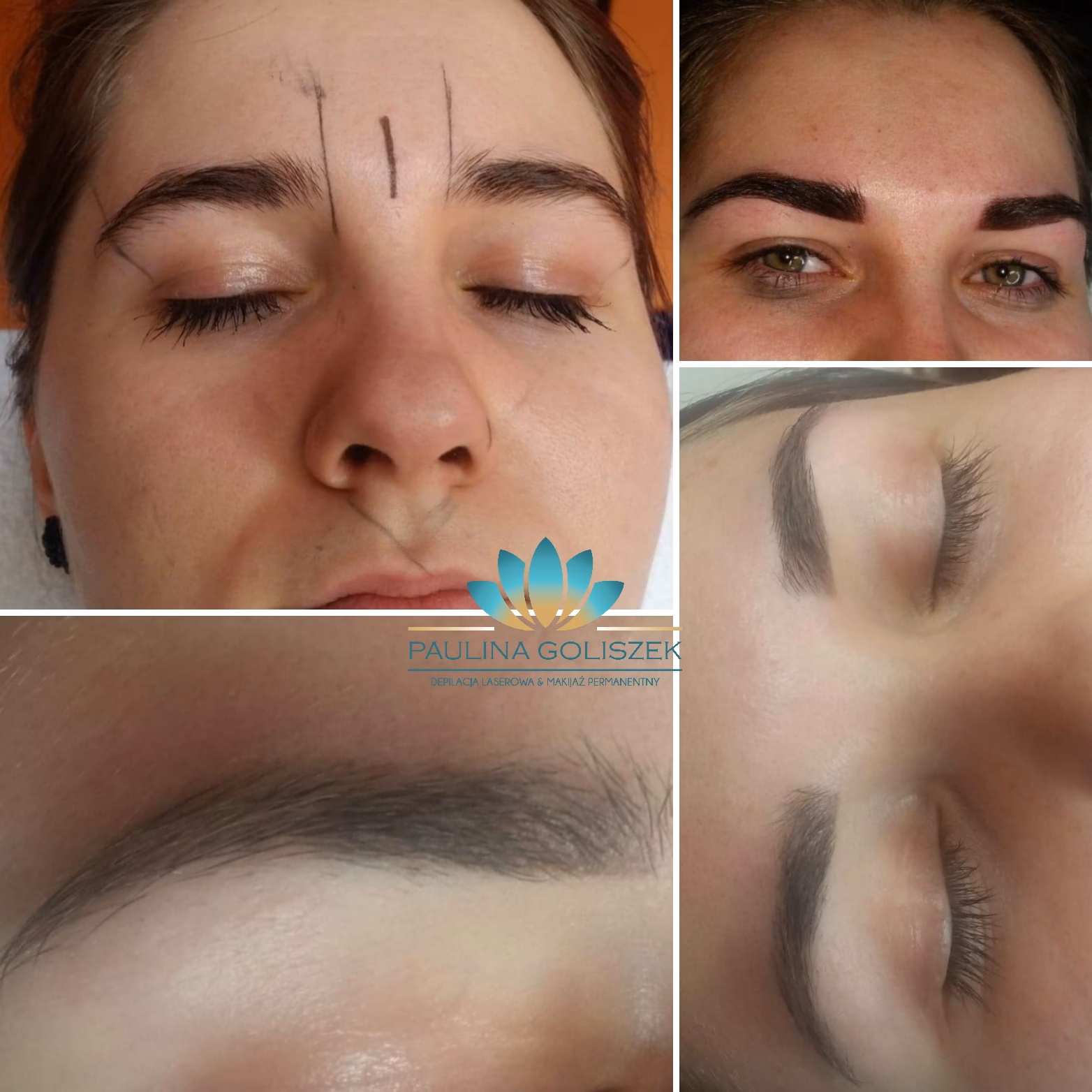 Czy można depilować laserem po tatuażu?