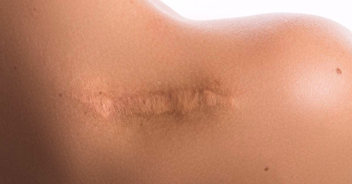 Czy mogę poddać się laserowemu usuwaniu owłosienia na uszkodzonej skórze?