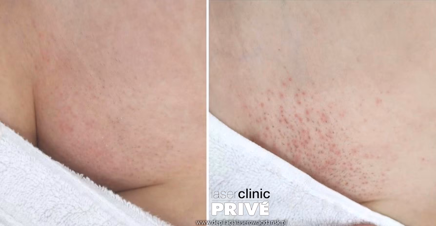 Ile kosztuje depilacja laserowa głębokiego bikini?