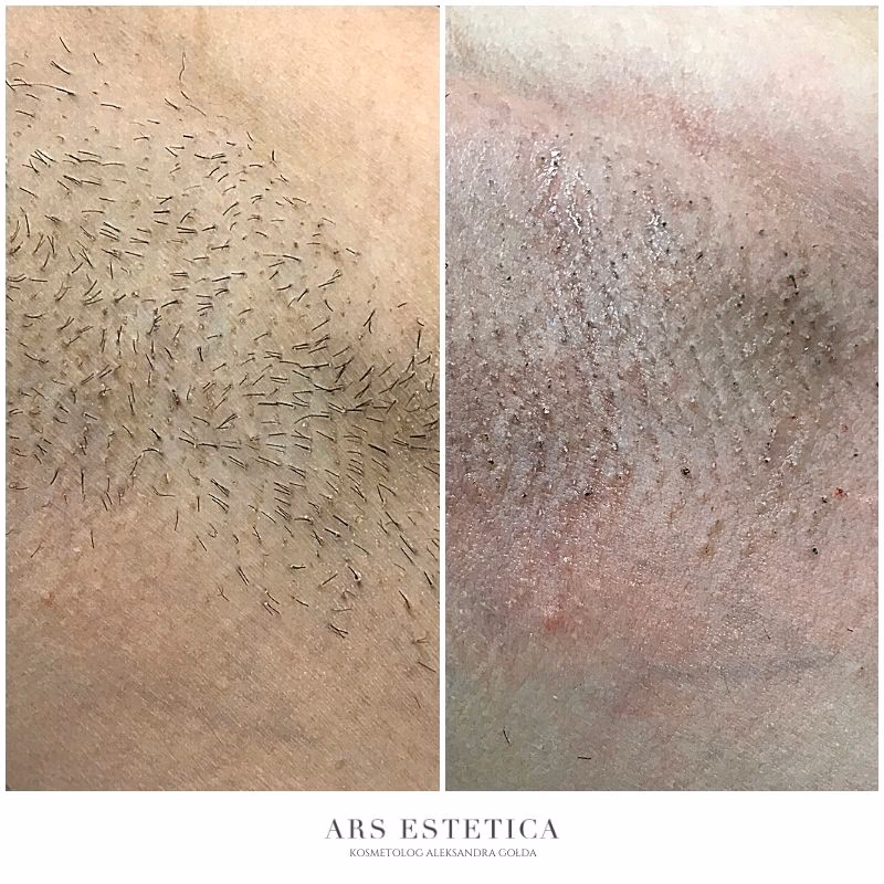 Po jakim czasie wypadają włosy po laserze?